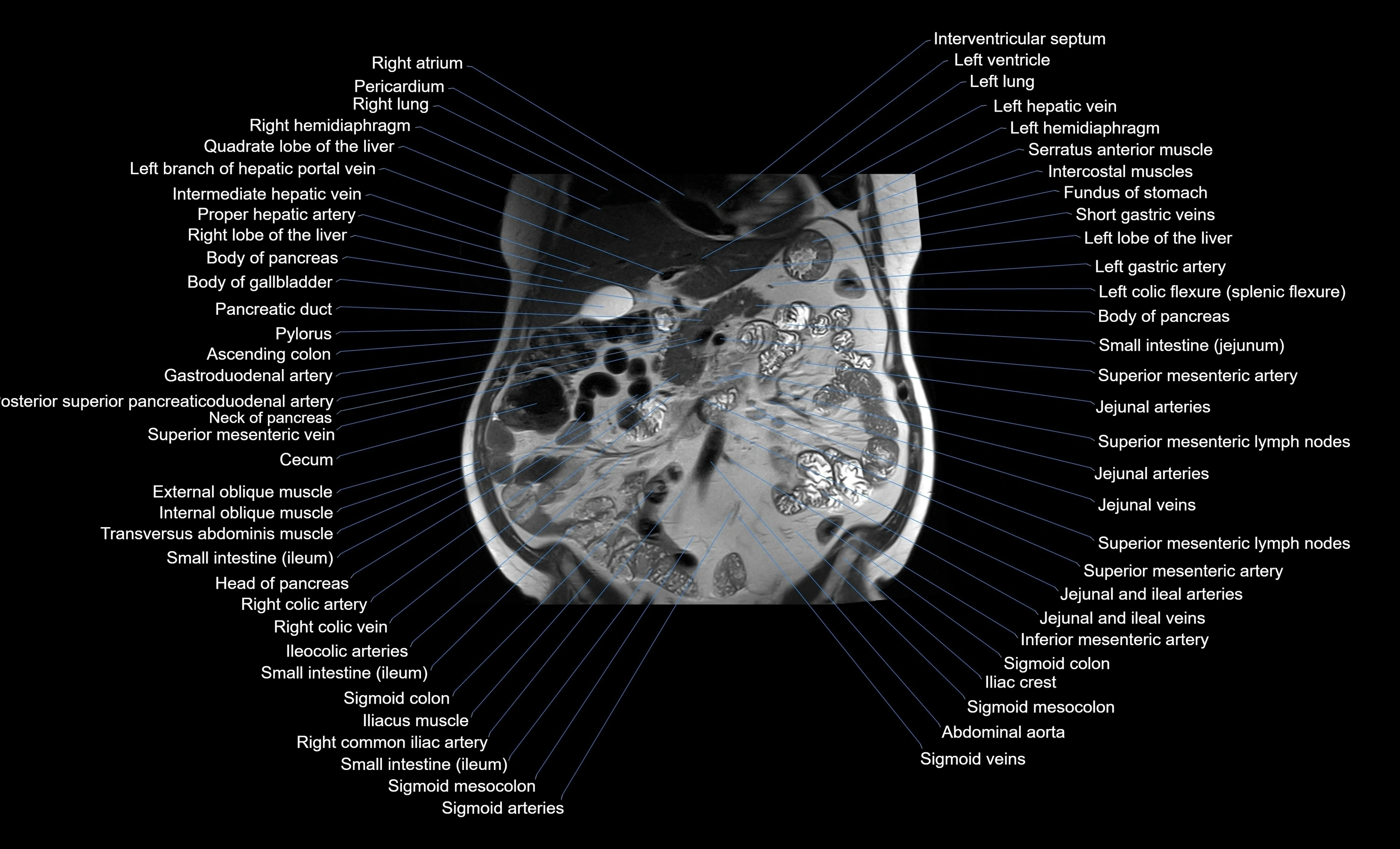 MRI Abdomen coronal labelled cross sectional anatomy radiology  image-img-00001-00025.webp